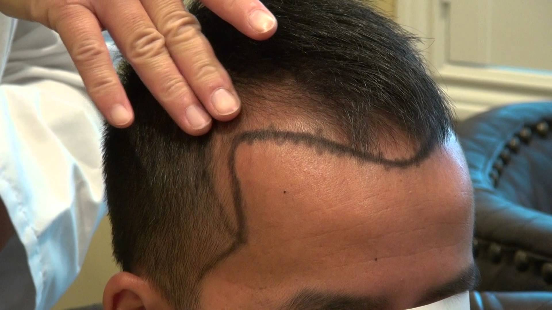 New Hair Transplant Technology 2023